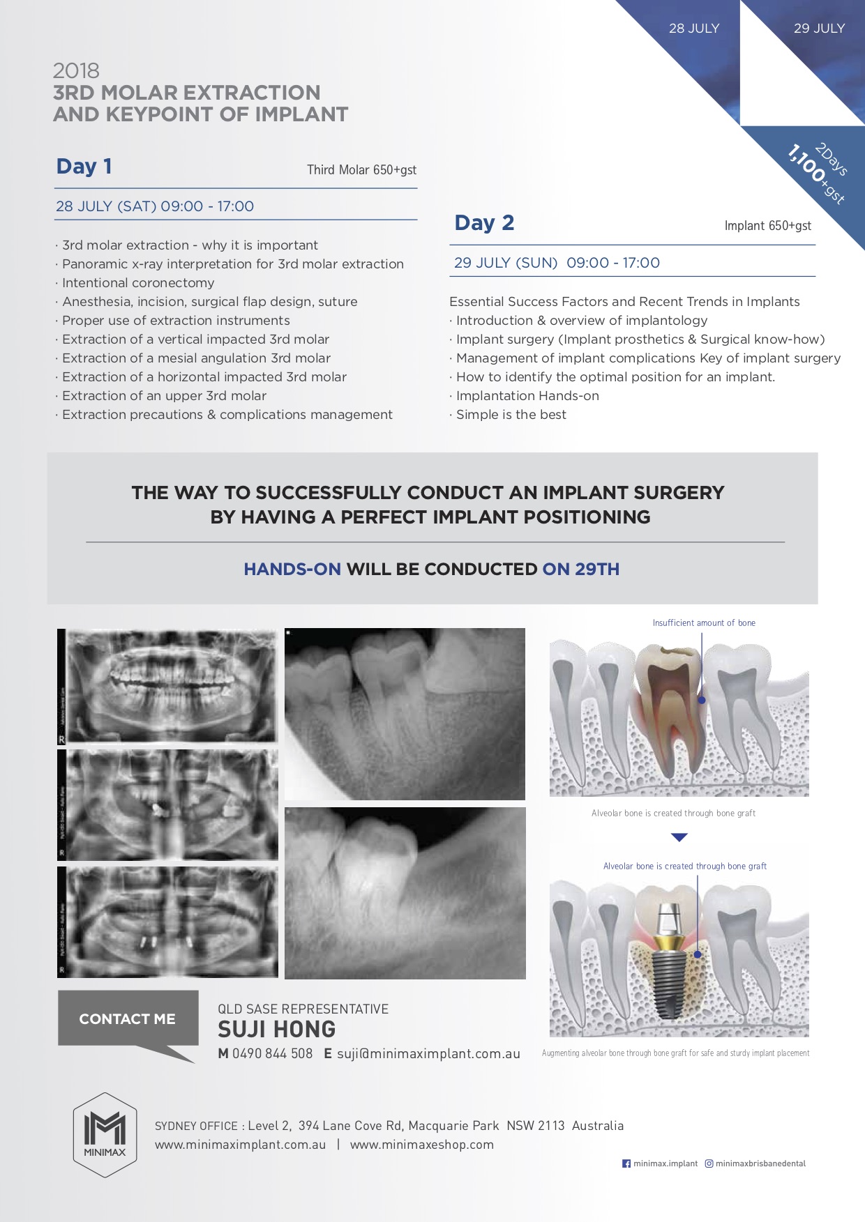 2018 3rd Moral Extraction and Keypoint of Implant-2