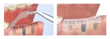 New-Ora-Aid-minimax-implant-2