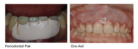 New-Ora-Aid-minimax-implant