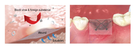 New-Ora-Aid-minimax-implant-2