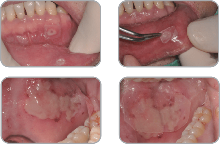 New-Ora-Aid-minimax-implant-clinical_case2