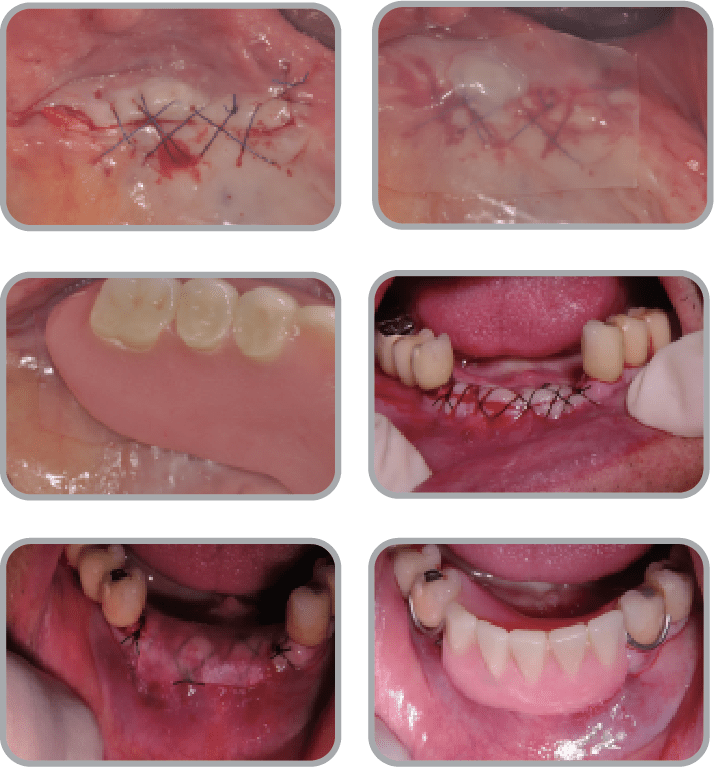 New-Ora-Aid-minimax-implant-clinical_case32