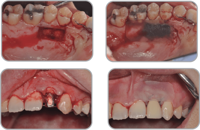 New-Ora-Aid-minimax-implant-clinical_case4