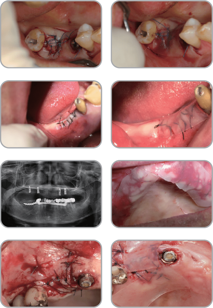 New-Ora-Aid-minimax-implant-clinical_case411