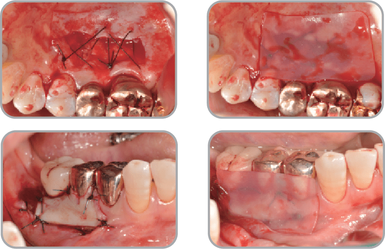 New-Ora-Aid-minimax-implant-clinical_case5