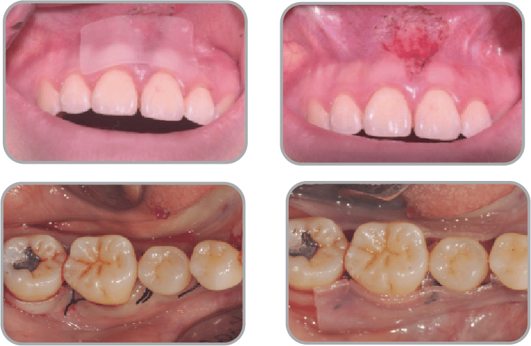 New-Ora-Aid-minimax-implant-clinical_caseNew-Ora-Aid-minimax-implant-clinical_case1 (1)