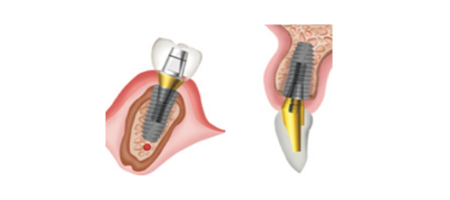 SUPER_line-dentium-2020-minimax-implant-1