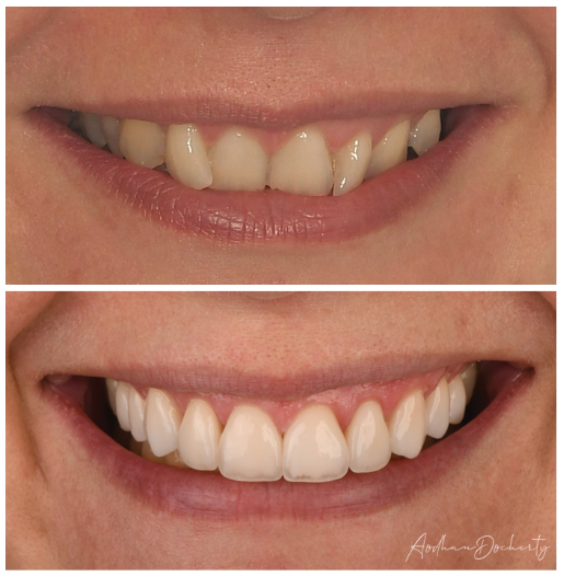 veneer before after