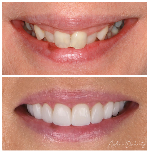 veneer before after