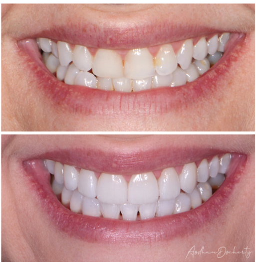 veneer before after