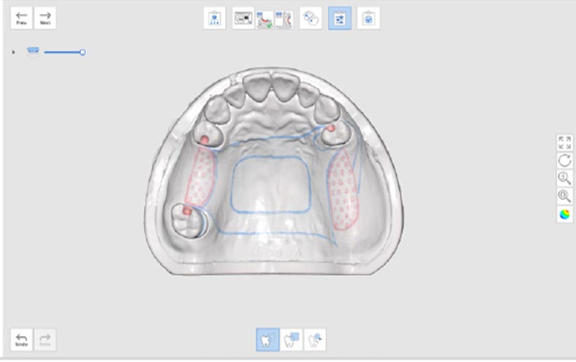 Partial denture