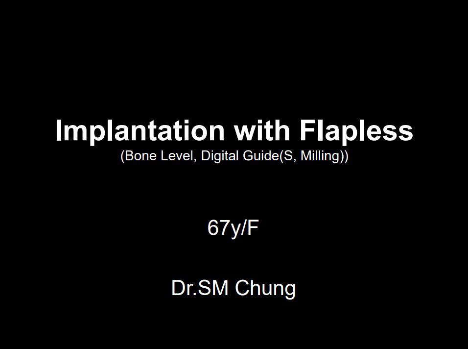 Anterior area Implantation with Flapless