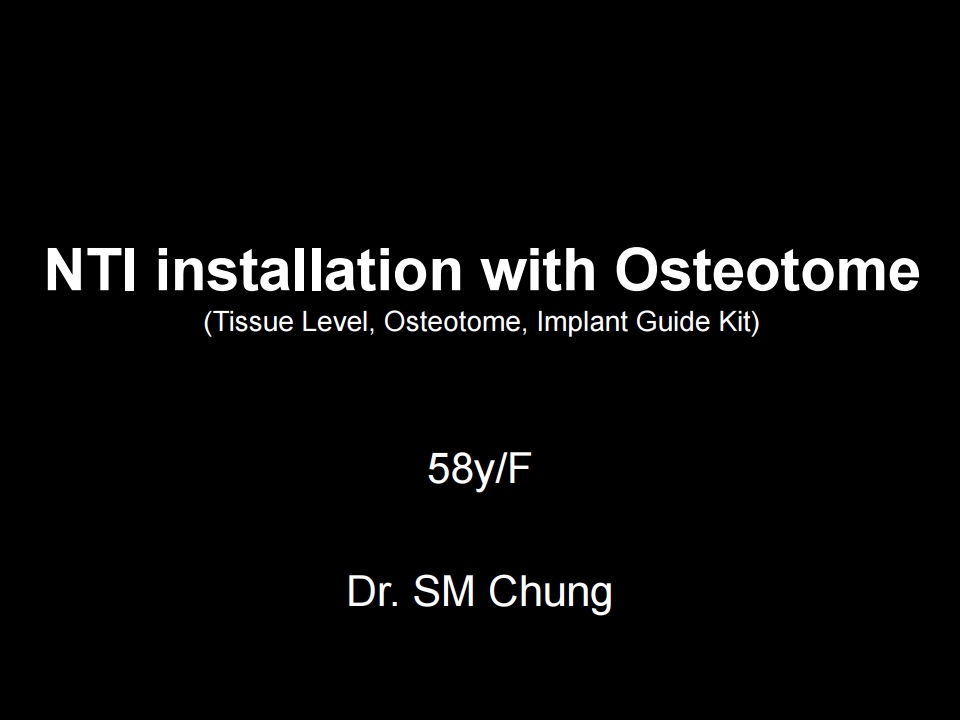 Bright implant installation with osteotome