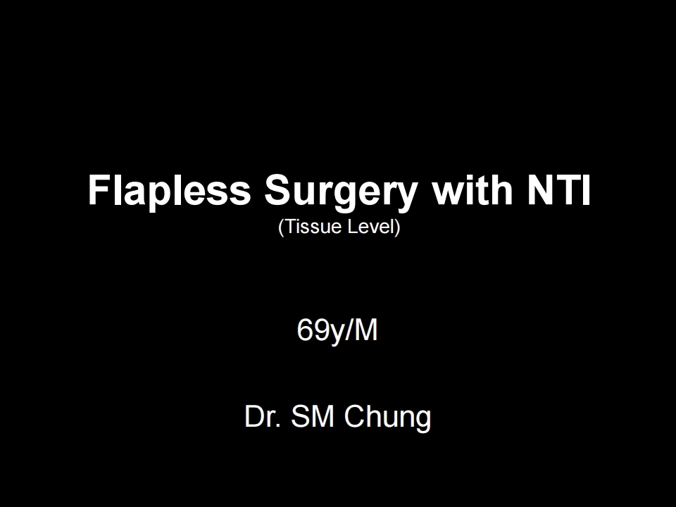 Flapless Surgery with NTI