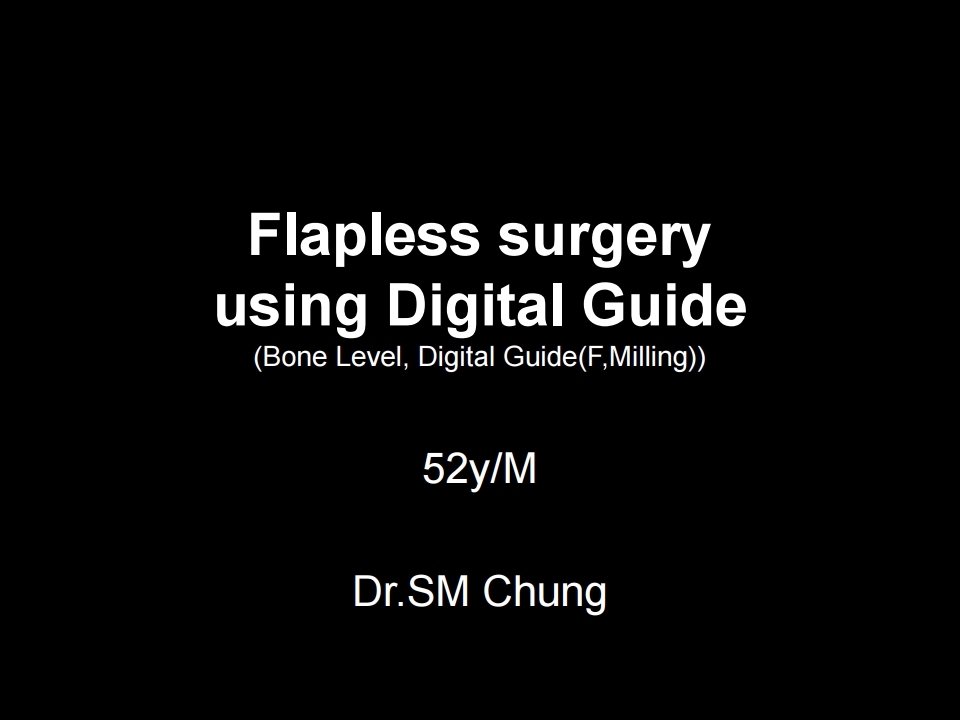 Flapless surgery using Digital Guide