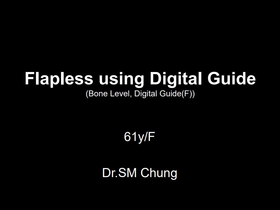 Flapless using Digital Guide