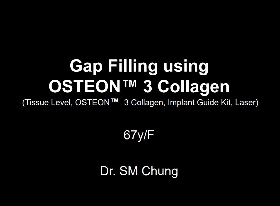 Gap Filling using Osteon™3 Collagen