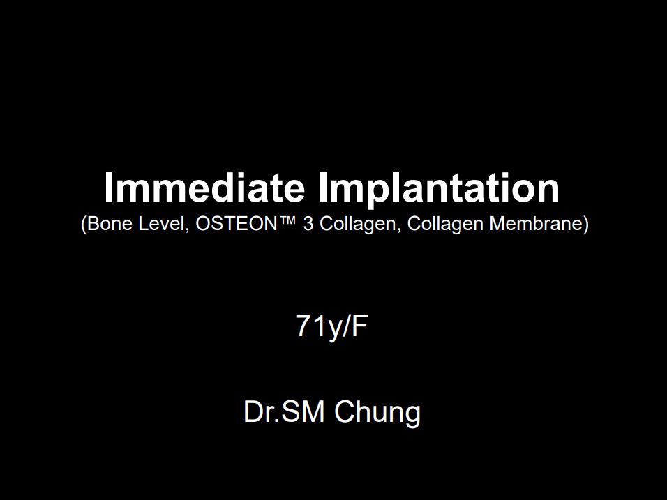 Immediate Implantation