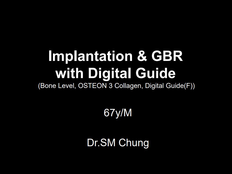 Implantation & GBR with Digital Guide