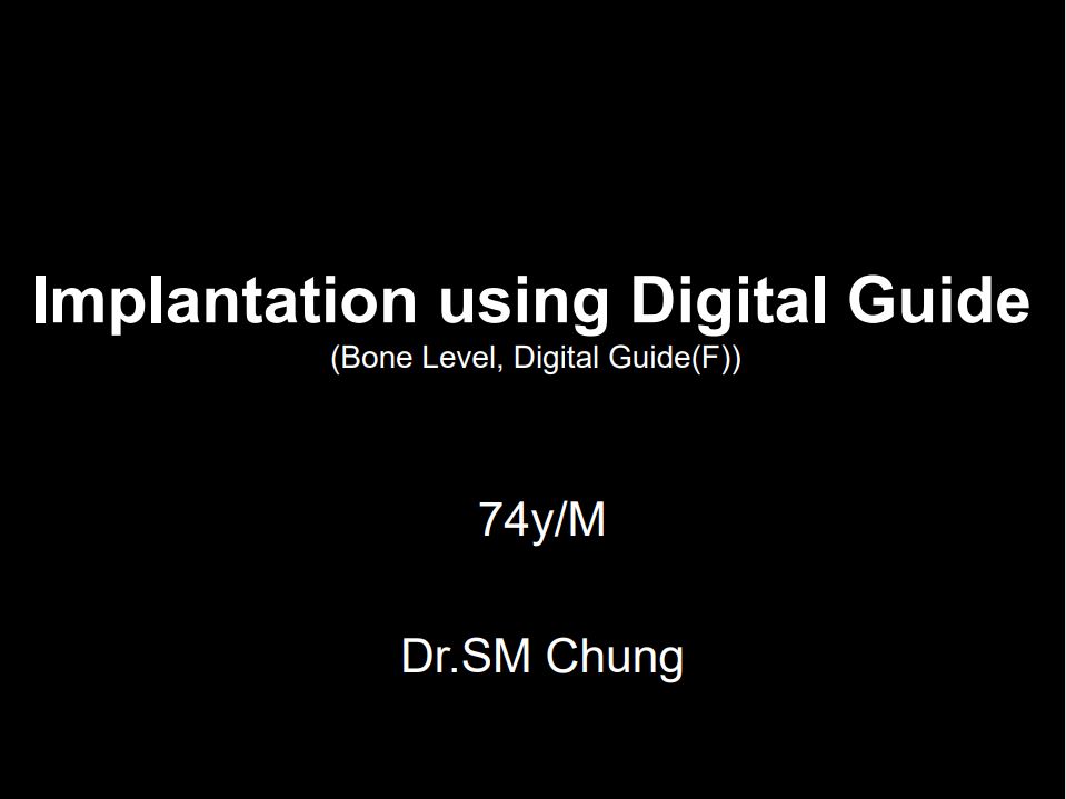 Implantation using Digital Guide