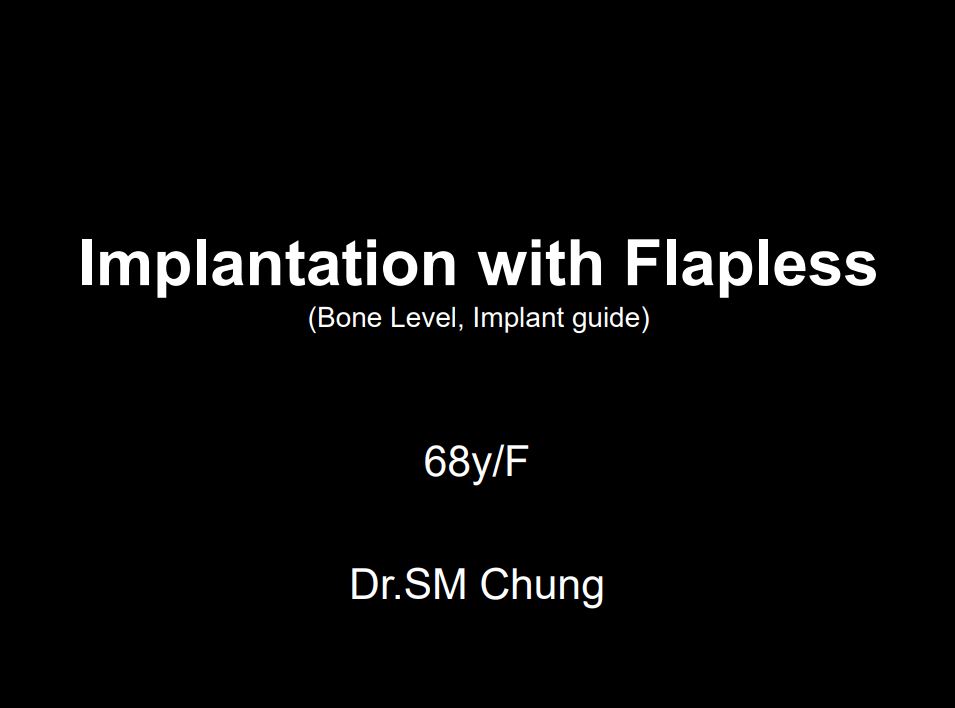 Implantation with Flapless