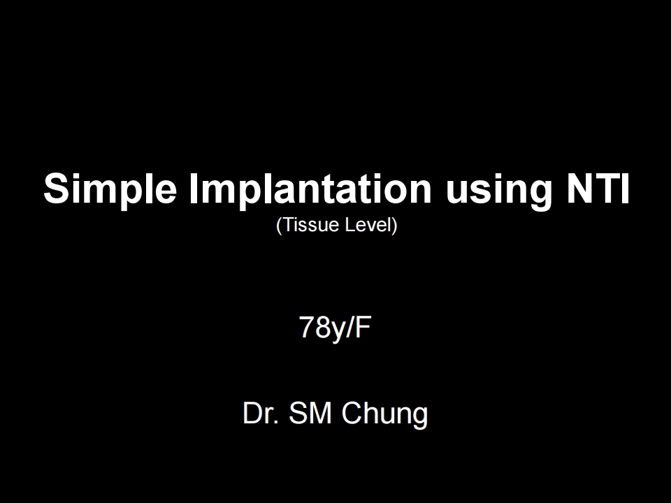 Simple Implantation using bright Tissue Level