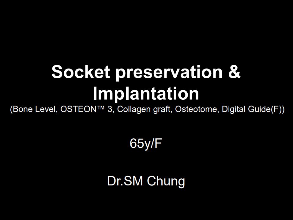 Socket preservation & Implantation