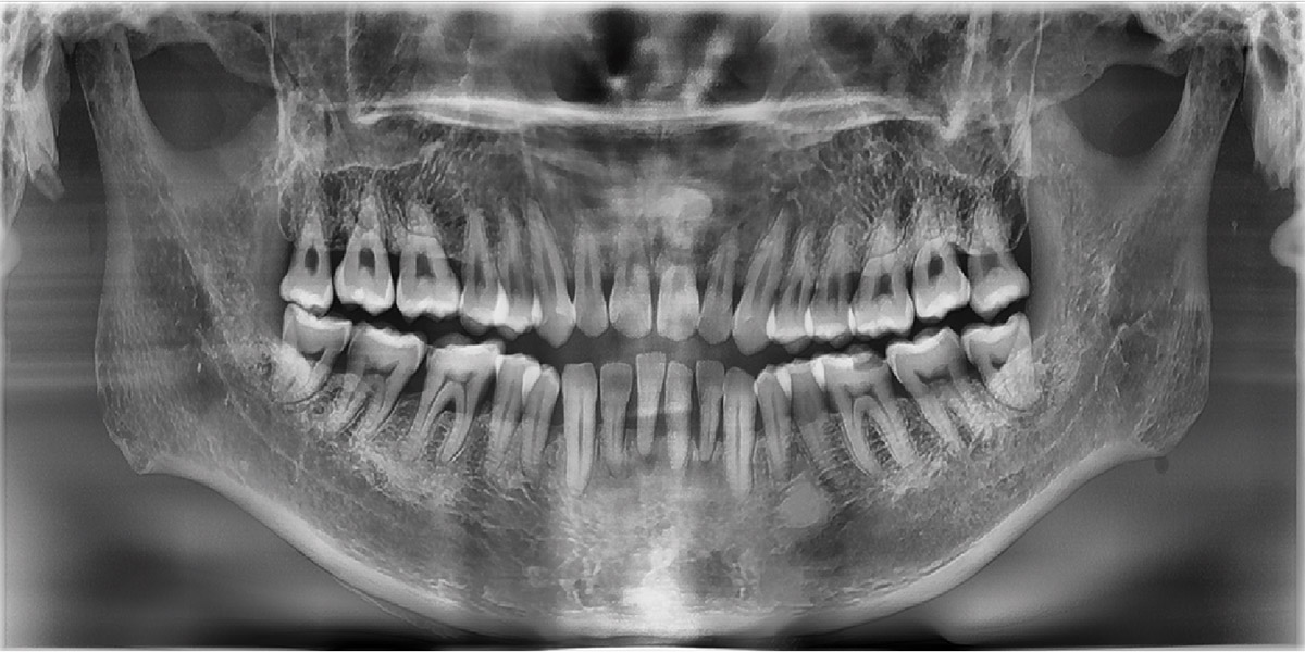 ADVANCED IMAGE SOLUTION FOR ACCURATE DENTAL DIAGNOSIS