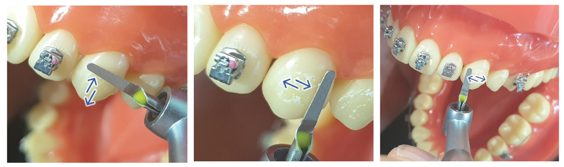 IPR Strips - Minimax Implant