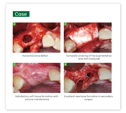 OssGuide Collagen Membrane