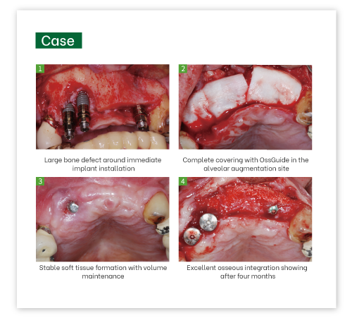 OssGuide Collagen Membrane