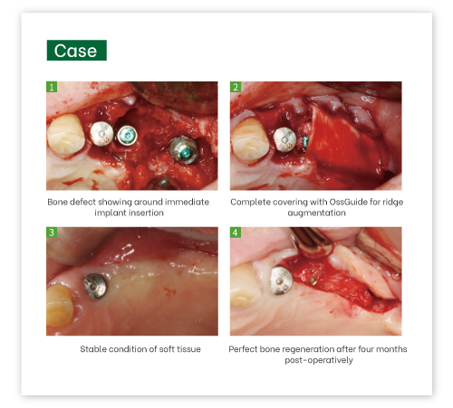 OssGuide Collagen Membrane