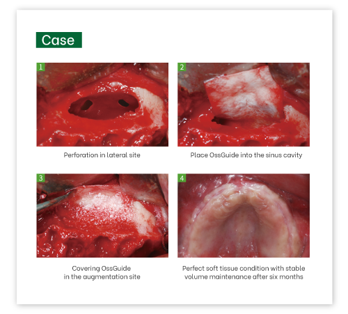 OssGuide Collagen Membrane