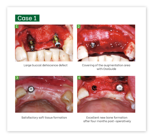 OssGuide Collagen Membrane