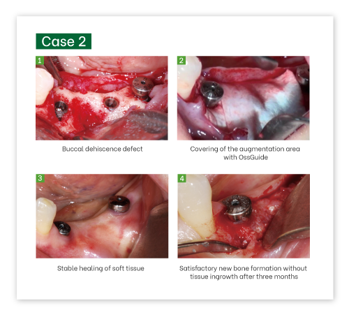 OssGuide Collagen Membrane