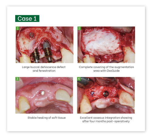 OssGuide Collagen Membrane