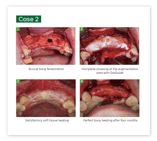 OssGuide Collagen Membrane